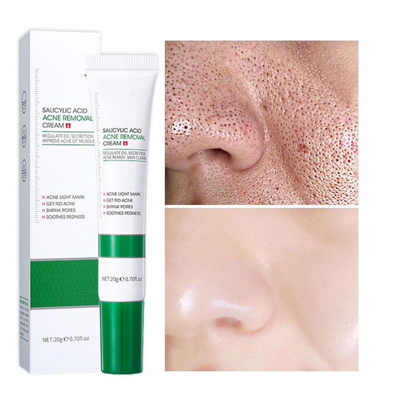 Salicylic Acid Acne Remove Acid Acne Cream 20g Blackhead Removal Anti ...