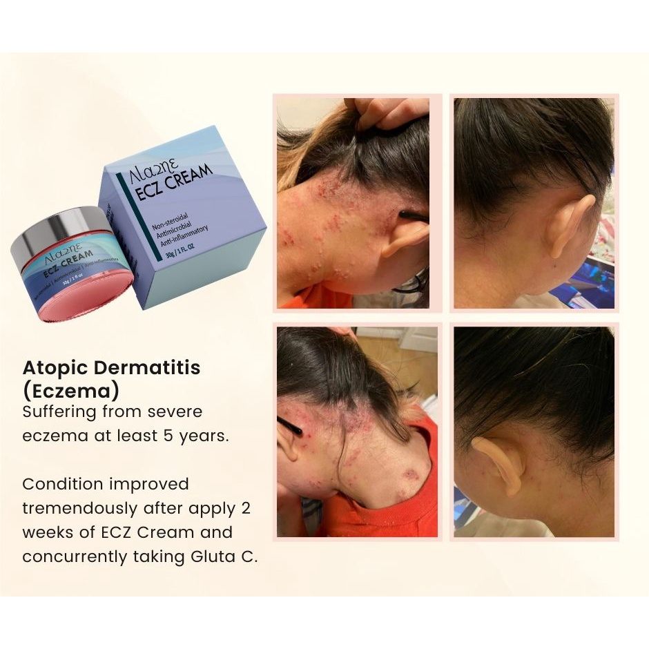 Alazne ECZ Cream Natural cream made from plants for Eczema