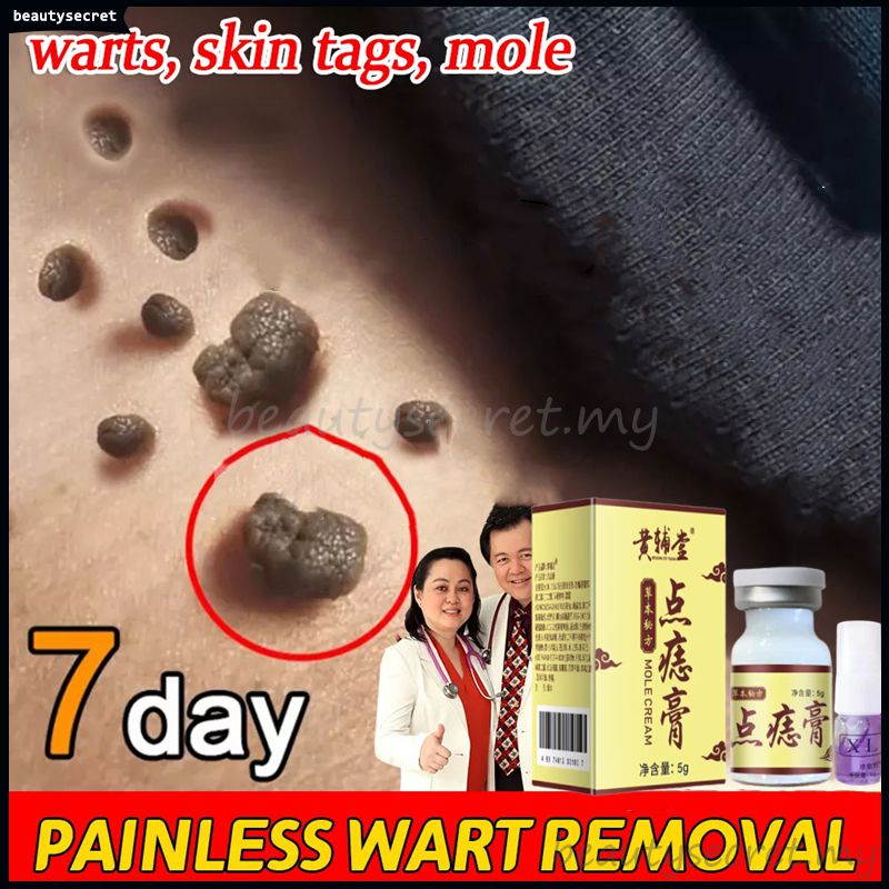 Ubat Kutil Tahi Lalat Ketuat Dan Biji Kolesterol Warts Removal Cream Skin Tag Removal Mole