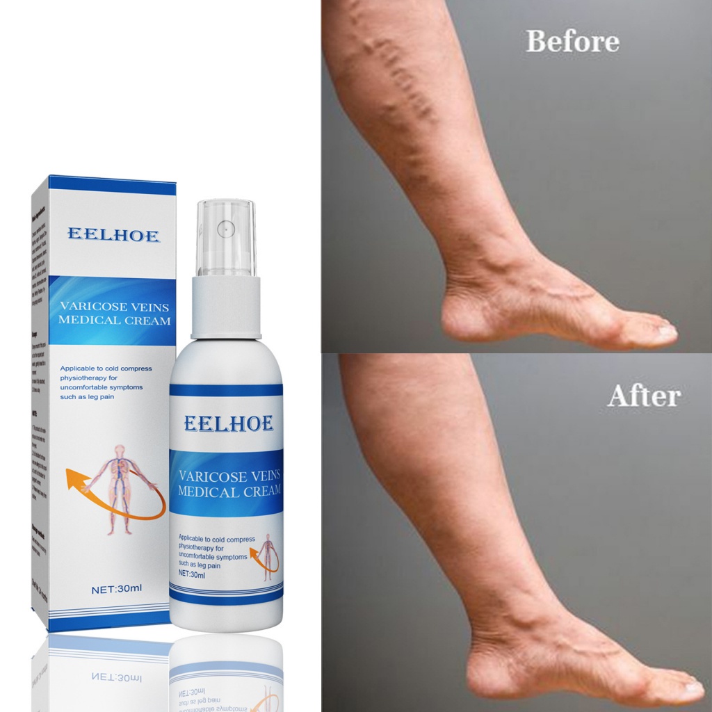 Hot-Selling#EELHOE Vein Massage Spray Relieve Leg Veins Smoothing ...