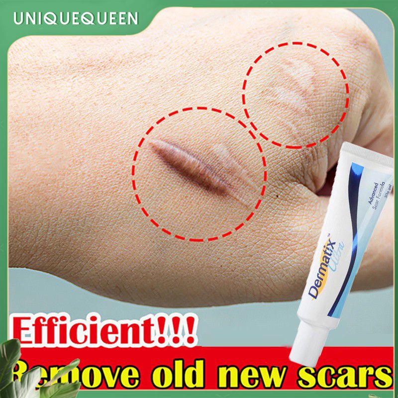 Dermatix Advance Scar Dermatix Ultra Scar Gel Scar Remover Cream Ubat Parut Luka Scar Cream Scar