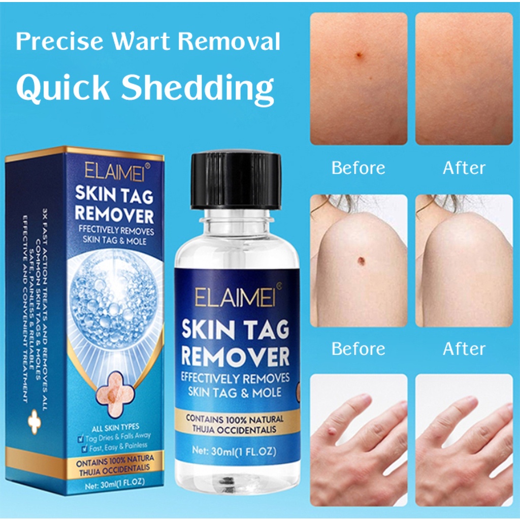 1-2pc-wart-remover-solution-for-common-warts-on-face-hands-feet-and