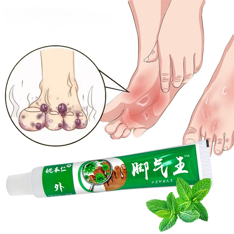 Anti Fungal Infections Beriberi Cream For Athlete's Foot Tinea Pedis ...