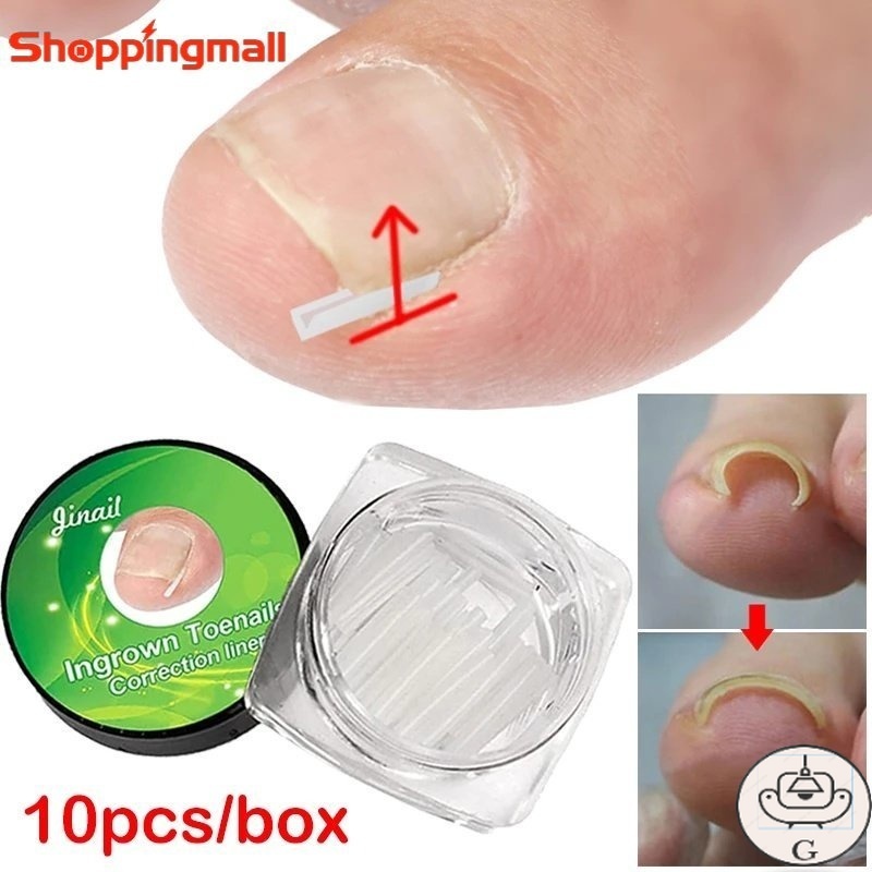 GS [Sunshine] 10Pcs Professional Ingrown Toenail Correction Tool ...