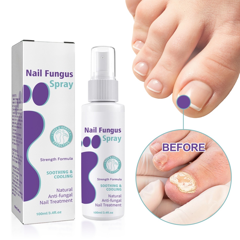 Fungal Nail Repair Spray Nursing Treatment Foot Nail Fungus Removal Gel ...