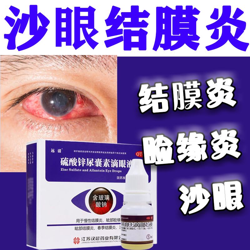 Treat conjunctivitis zinc sulfate allantoin eye drops keratitis heat