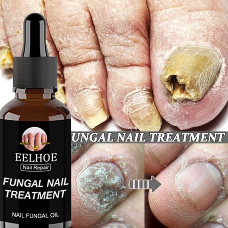 Nail Fungus Treatment Nail Antifungal Nail Repair Stop Fungal Growth