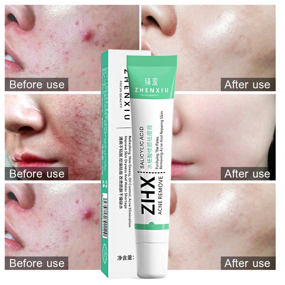 Acne cream pimple scar remover face whitening cream skin care acne