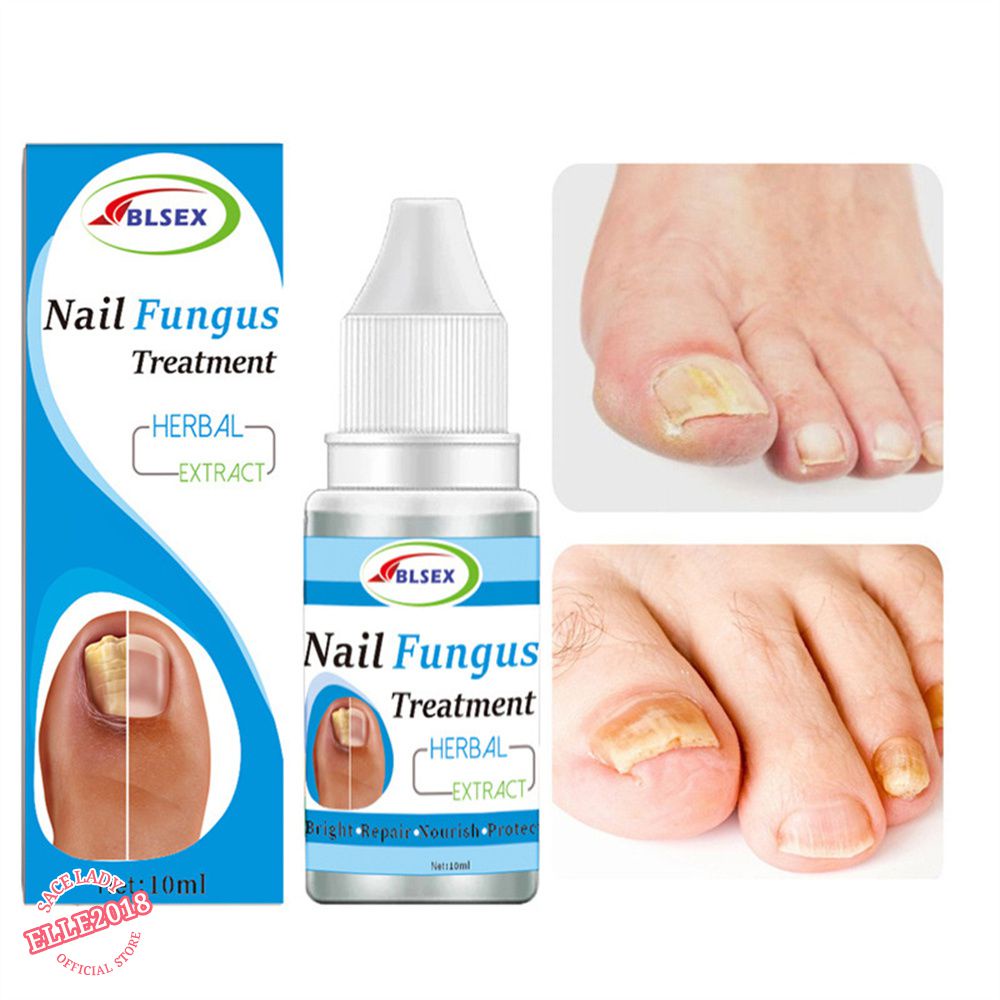 Mild Antifungal Solution Natural Onychomycosis Treatment Liquid