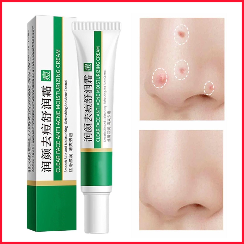 Pimple Remover Cream Oil Control Skin Cream Herbal Pimple Removal Cream
