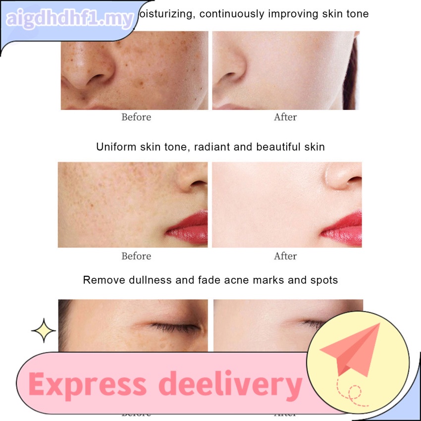 Face Skin Care Freckles Cream Remove Melasma Dark Spot Lightening