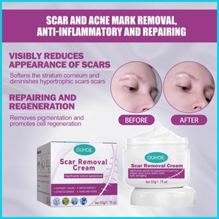 Scar Removal Cream Repair Old Scars Repair Ubat Krim Hilangkan Parut ...