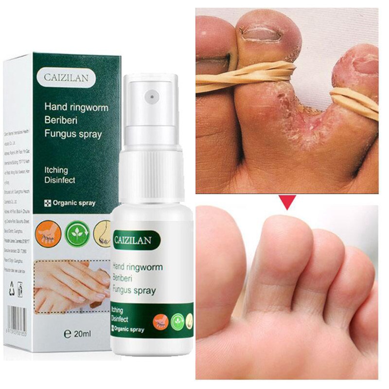 Anti Fungal Spray Foot Fungus Cream Relieve Beriberi Toe Treatment Gel ...