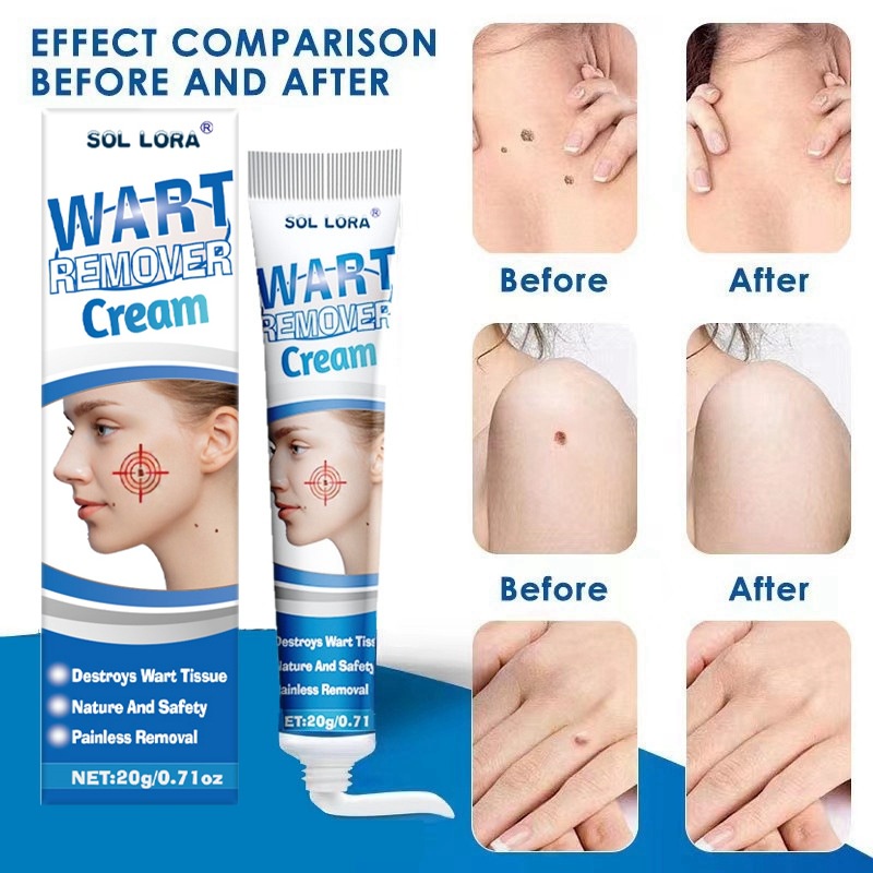 Warts Remover Original Cream Wart Removal Wart Treatment Skin Tags Mole