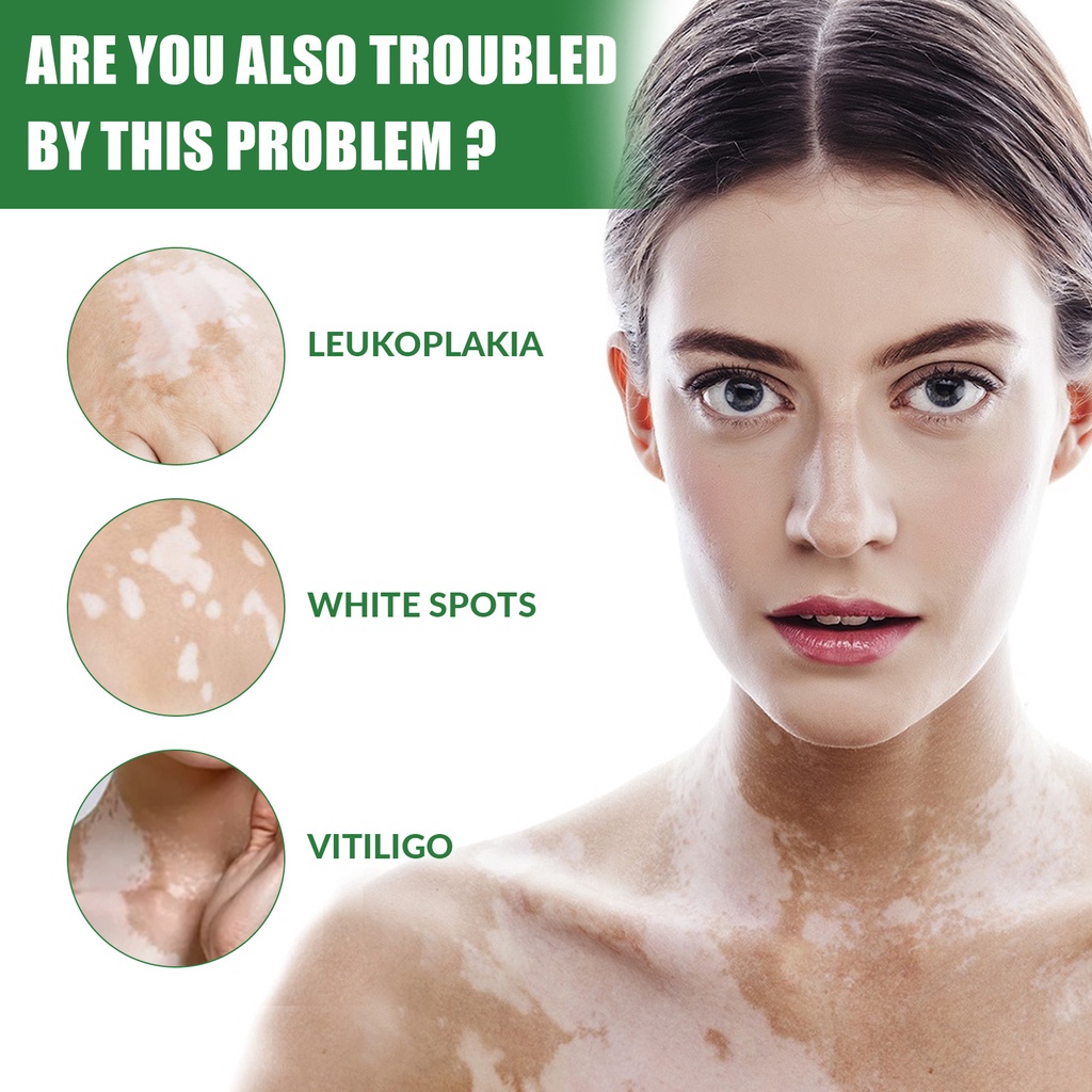 Vitiligo repair cream skin tone uniform skin tone care cream melanin