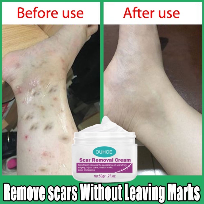 Scar Remover Cream Remove Stretch Mark Repair Cream Mosquito bite scar