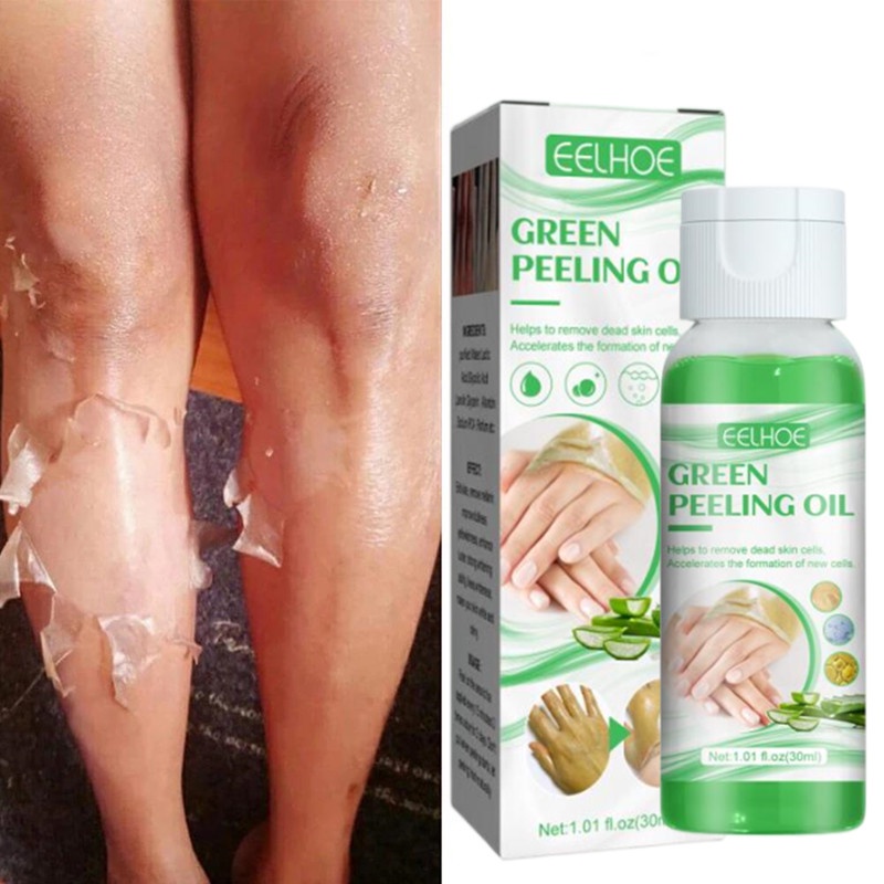 Green Peeling Oil Bleaching Dark Skin Spots Blackheads Blemishes Bad