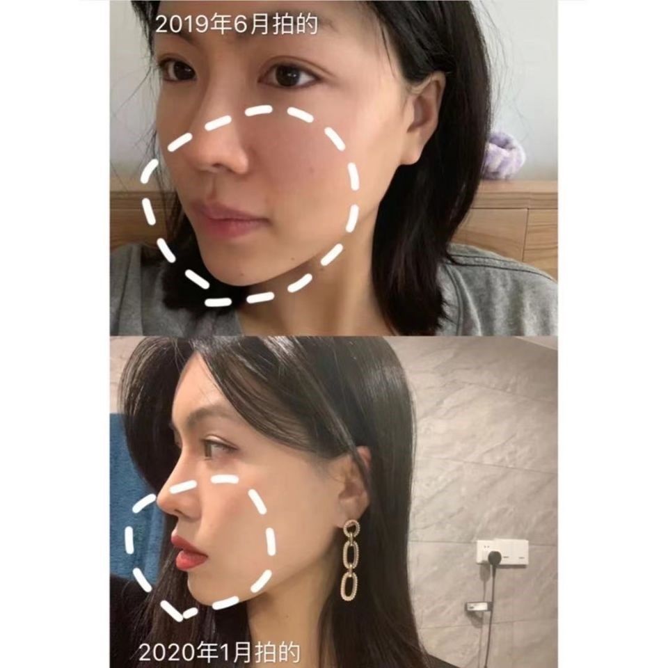 Straw Strawing Facial Wrinkles, Eliminating Magic Instruments, Facial