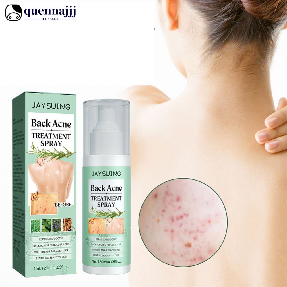 QUENNA 120ml Back Acne Treatment Spray Repair Back Shoulder Acne Clean