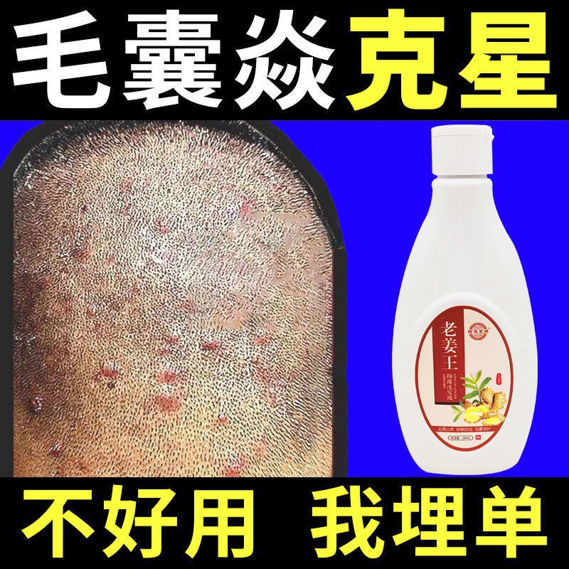 Folliculitis Antipruritic Shampoo Folliculitis Shampoo Pustule Dandruff Removal Head Tinea