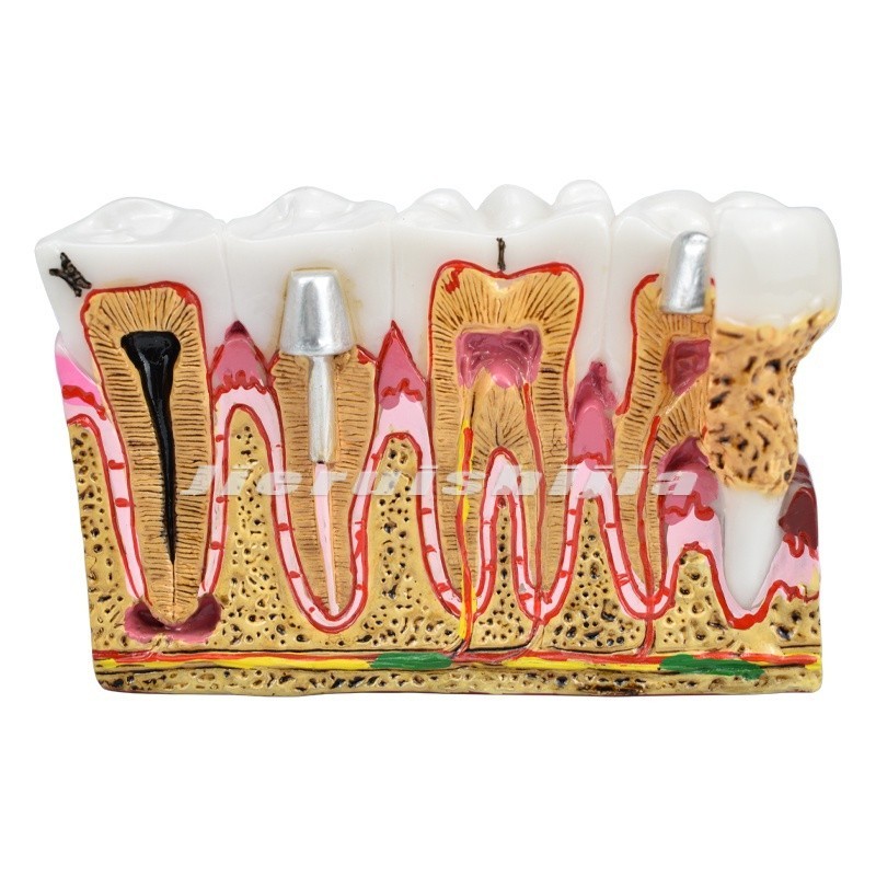 Dental Caries Model Tooth Model Oral Teaching Model Teeth Model Dental ...