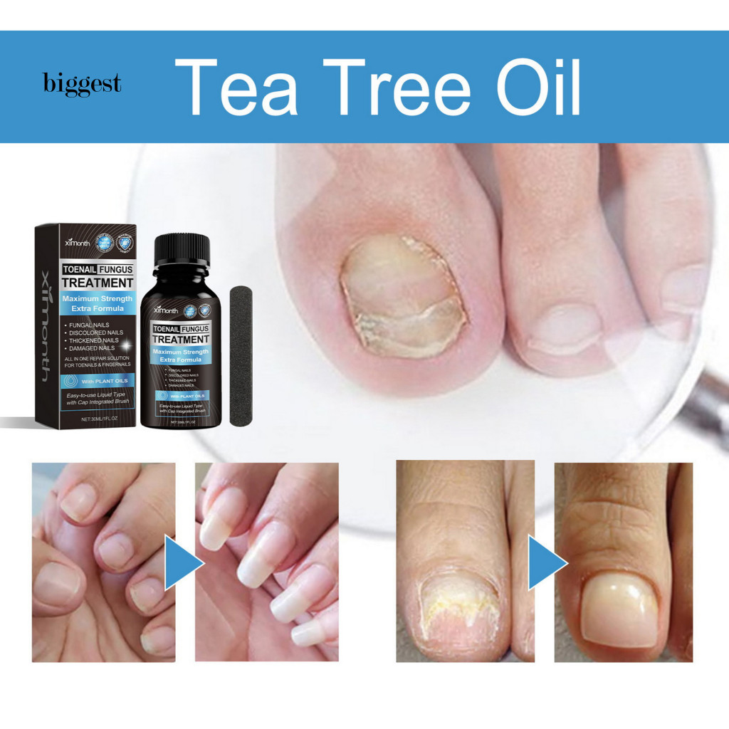 BGT Almond Oil Nail Renewal Toenail Fungus Solution Powerful Nail