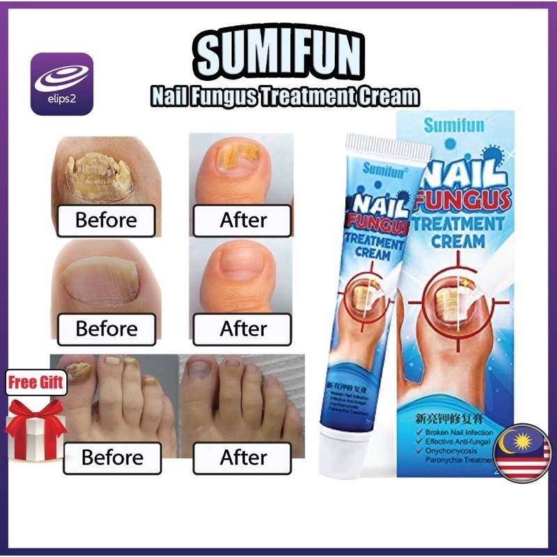 Kulat Kuku Nail Fungus Treatment Cream Sumifun Nail Fungus Onikomikosis ...