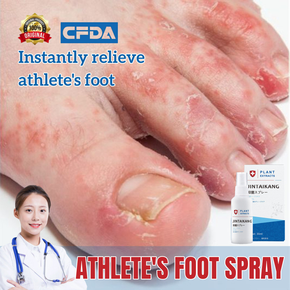 Athlete's Foot Spray Foot Odor Itchy Feet Peeling Blisters Treatment