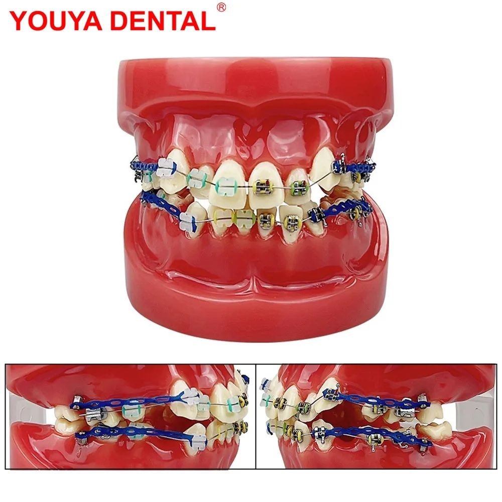 Dental Teeth Model Orthodontic Treatment Model Half Metal Half Ceramic ...