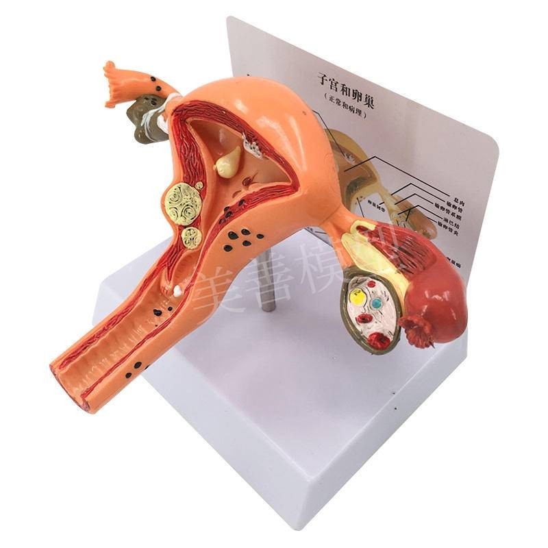 {Teaching Model} Female Pathology Uterus Model Woman Generates Ovulture ...