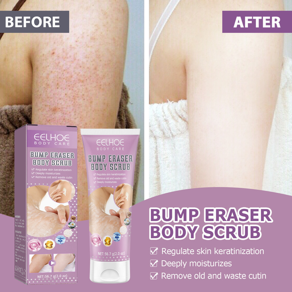 Bump Eraser Body Scrub Exfoliant for Keratosis Pilaris with 10 AHA All