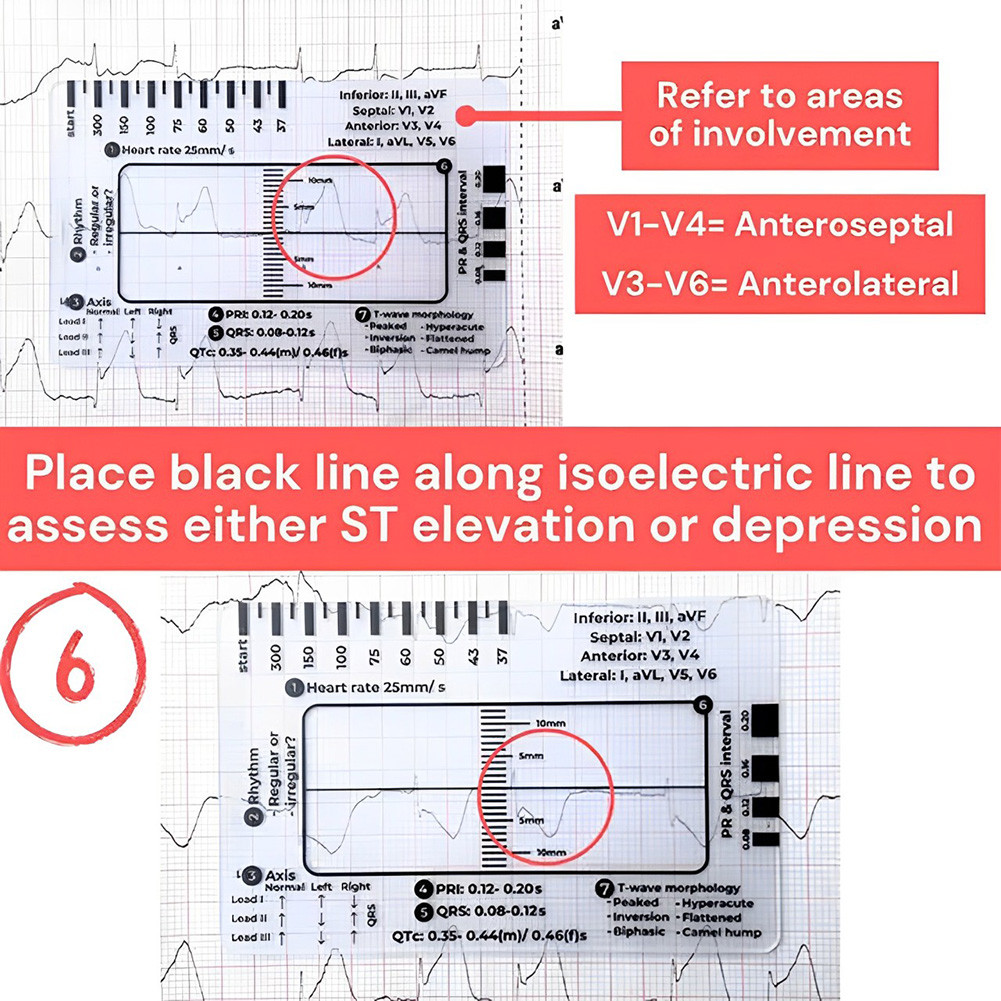 [Seriena.my] ECG 7 Step Ruler Portable ECG Measuring Card Reference ...