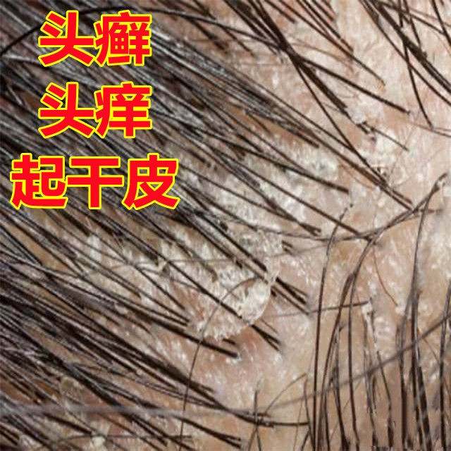 Shopkeeper's selection# tinea capitis Scalp pruritus scaly red rash ...