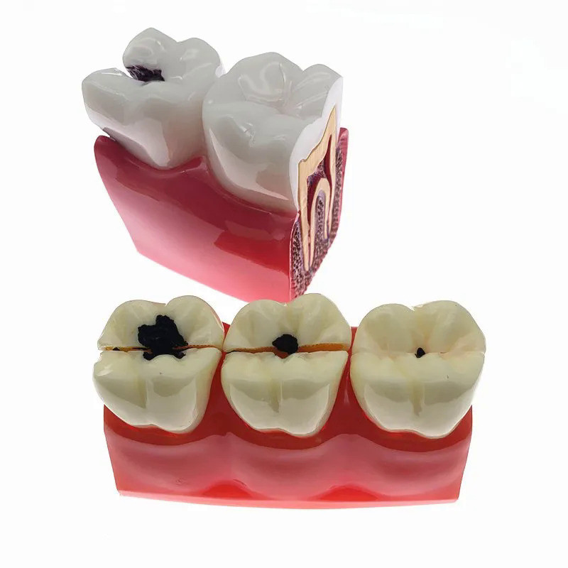 Teeth Model Caries Comparation Study Models 4Times/6times Caries model ...