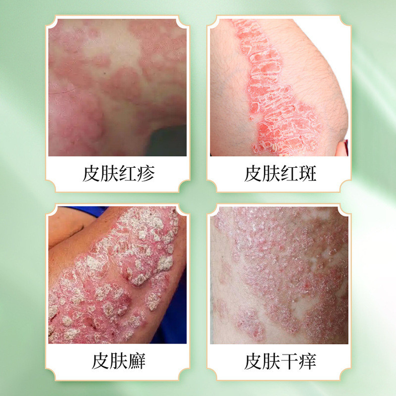 Qiuya Cowhide Anti-itch Cream 30g Soothes Itchy Skin Red Spots Red Rash ...