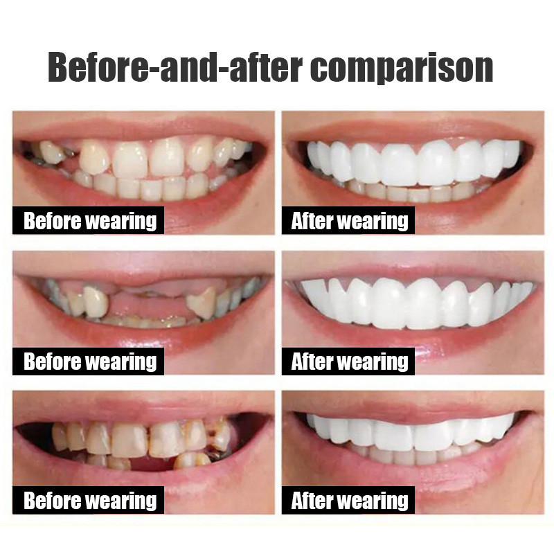 Adjustable Denture Teeth Set Natural Instant Smiling Veneer Denture ...