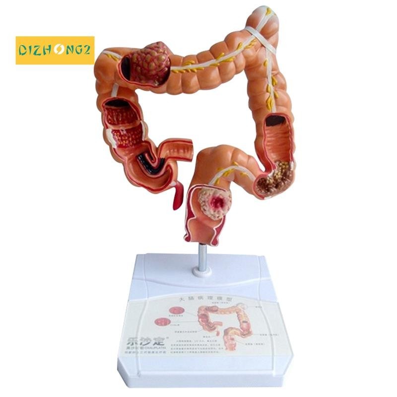 Teaching Model,Human Large Intestine Anatomy Model Visceral Lesion ...