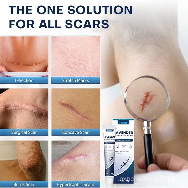 Scar cream 20g hyperplastic scar repair caesarean section scar stretch ...