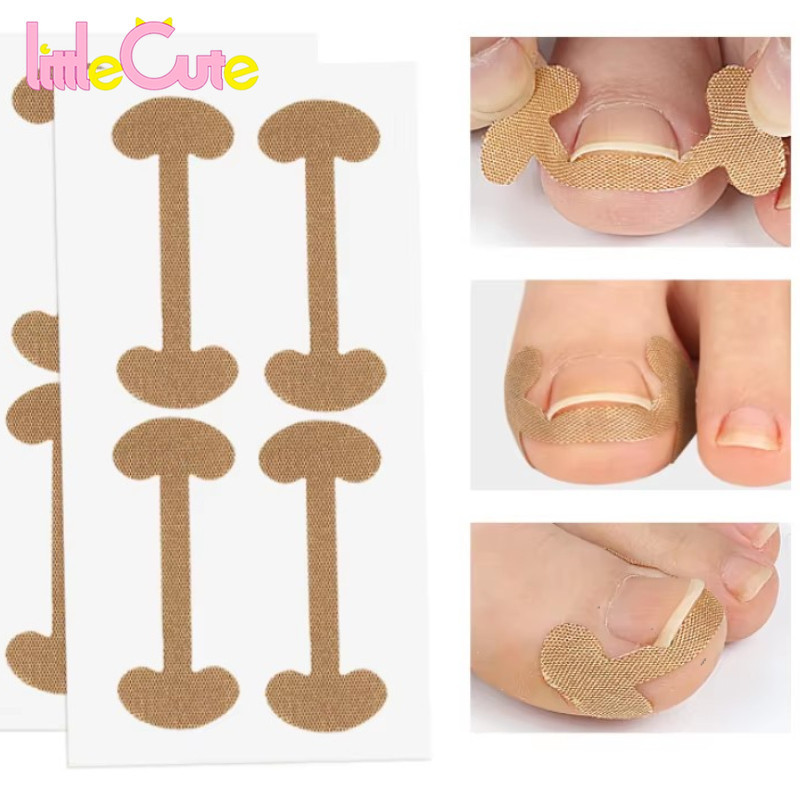 Ingrown Toenail Correction Sticker - Paronychia Treatment Stickers ...
