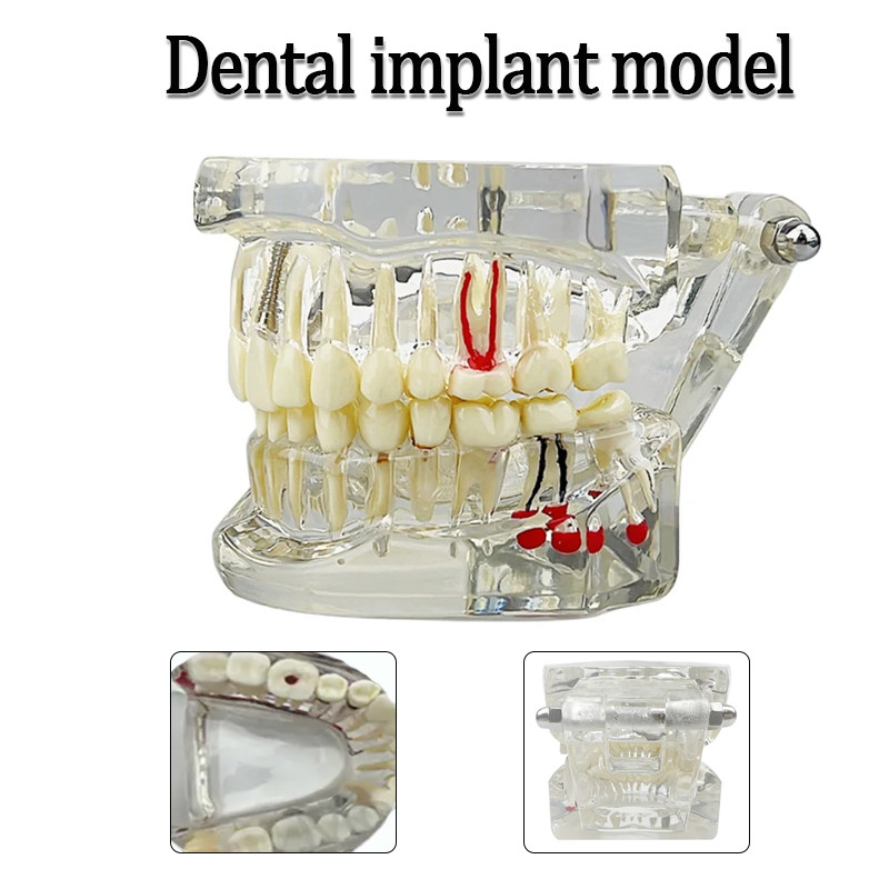 Dental Oral Typodont Model Implant Pathological Removable Teach Demo Transparent