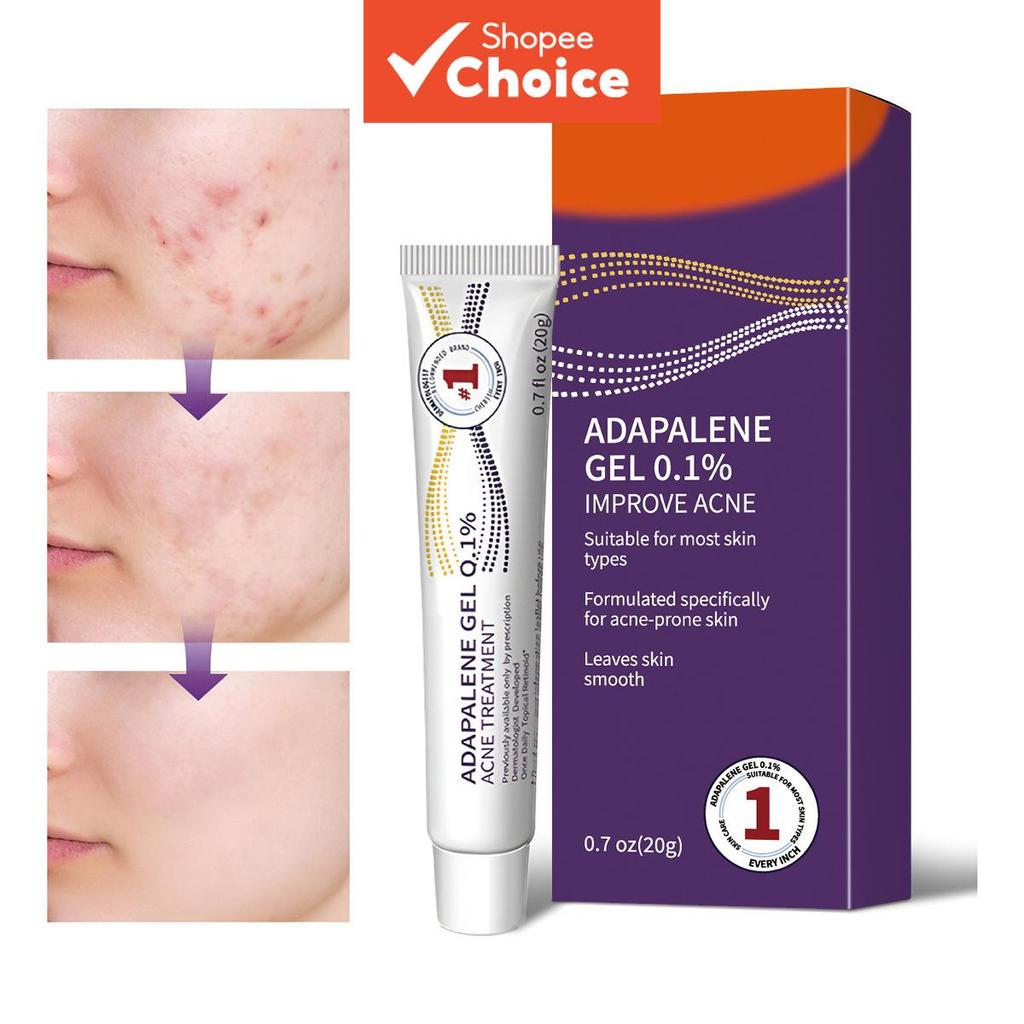 Adapalene Gel Anti Acne Facial Treatment Specially For Acne Prone ...