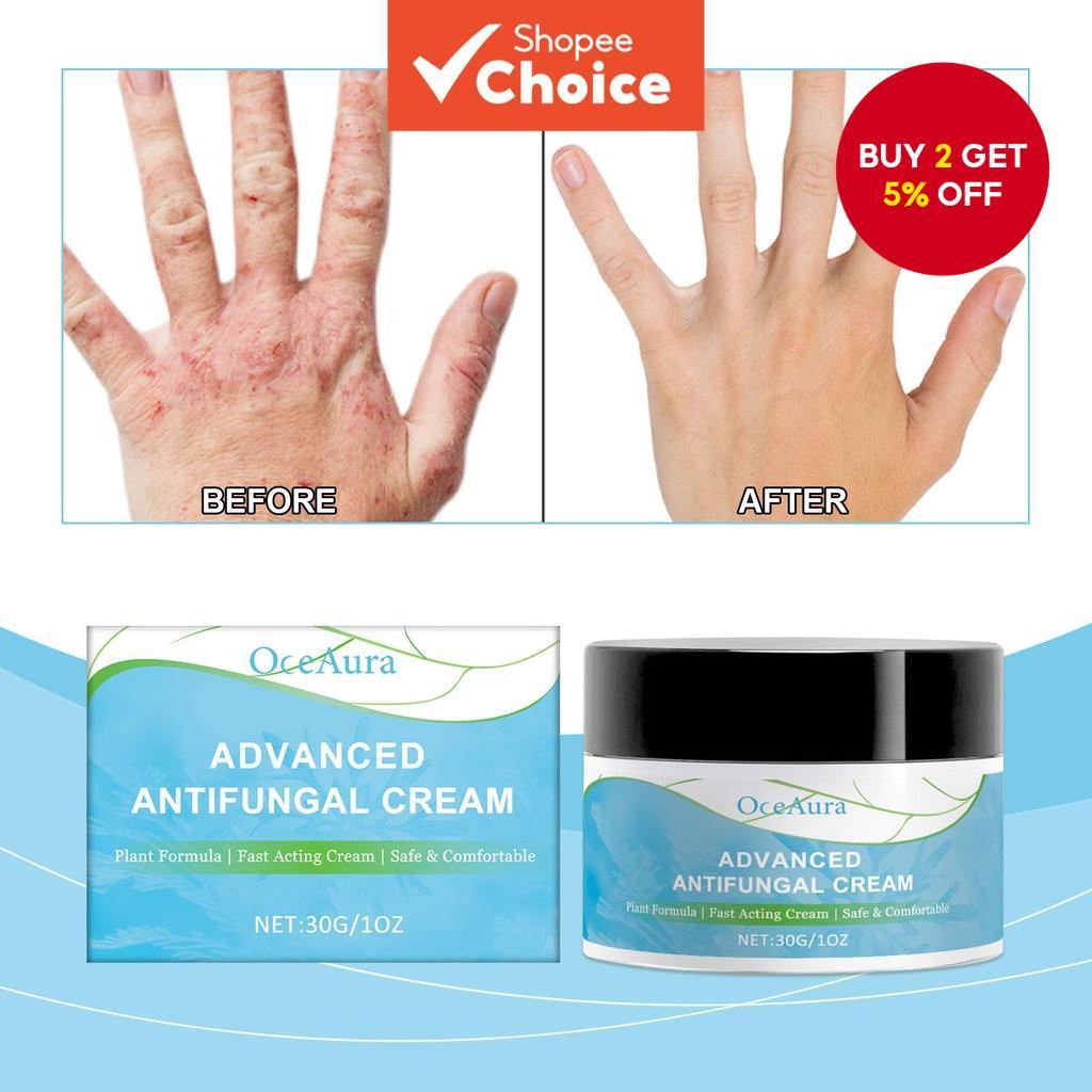 Anti-Fungal Ringworm Fungisol Antifungal Psoriasis Cream 30g - Tea Tree ...