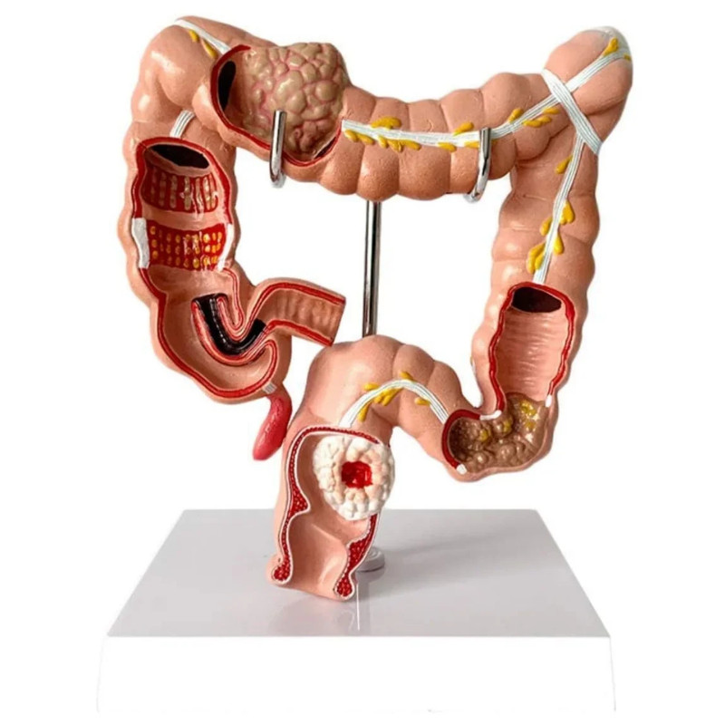 Human Large Intestine Anatomical Model Visceral Lesion Model Colon ...