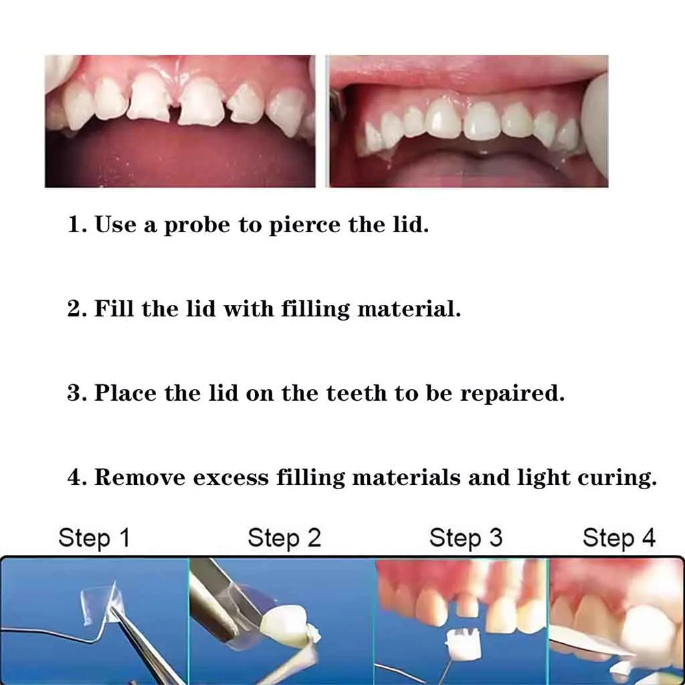 Dental Transparent Crowns Adult Kids Dentist Kit 1.910/1.912 Temporary ...