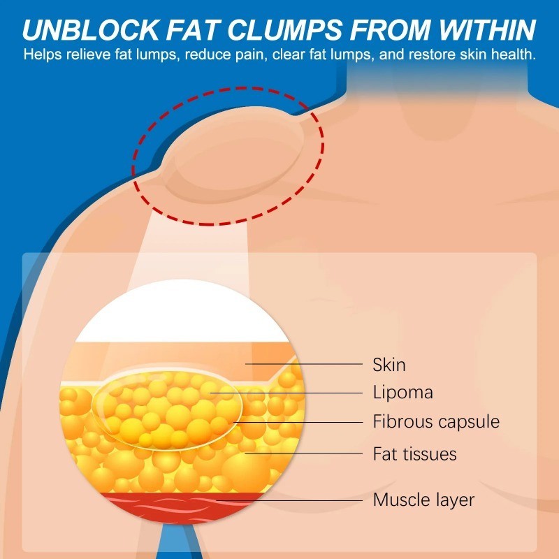 Anti Lipoma Spray Treat Fat Mass Lump Nodule Neck Lymphatic Drainage ...