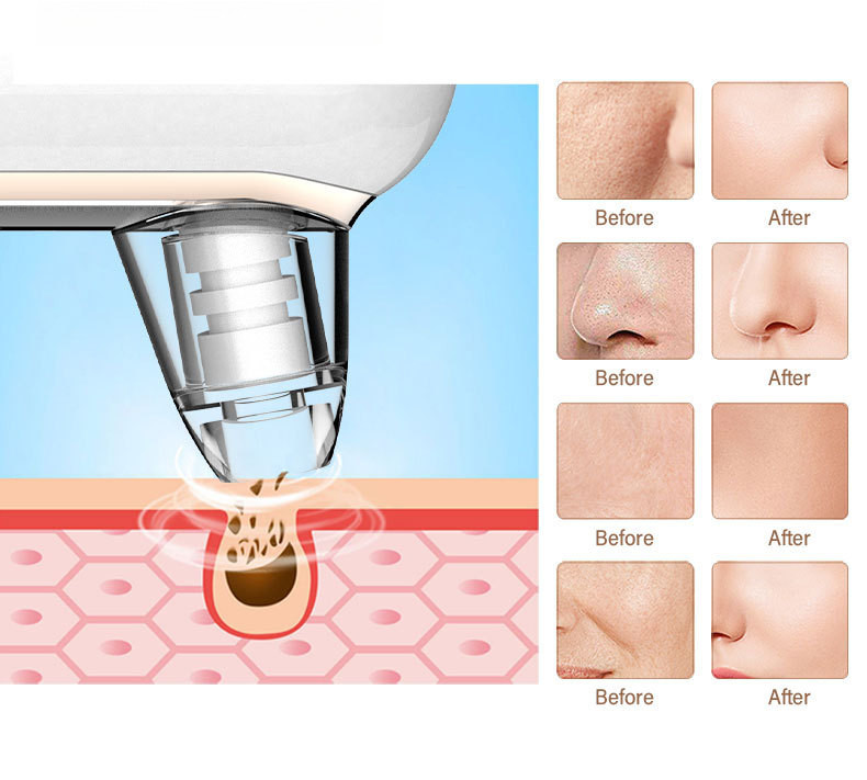 New Product Beauty Instrument Electric Blackhead Acne Cleaner Facial ...