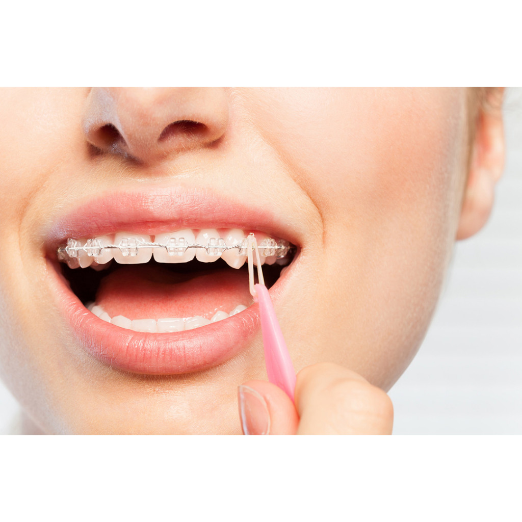 D4F Elastic placers orthodontist | Shopee Malaysia