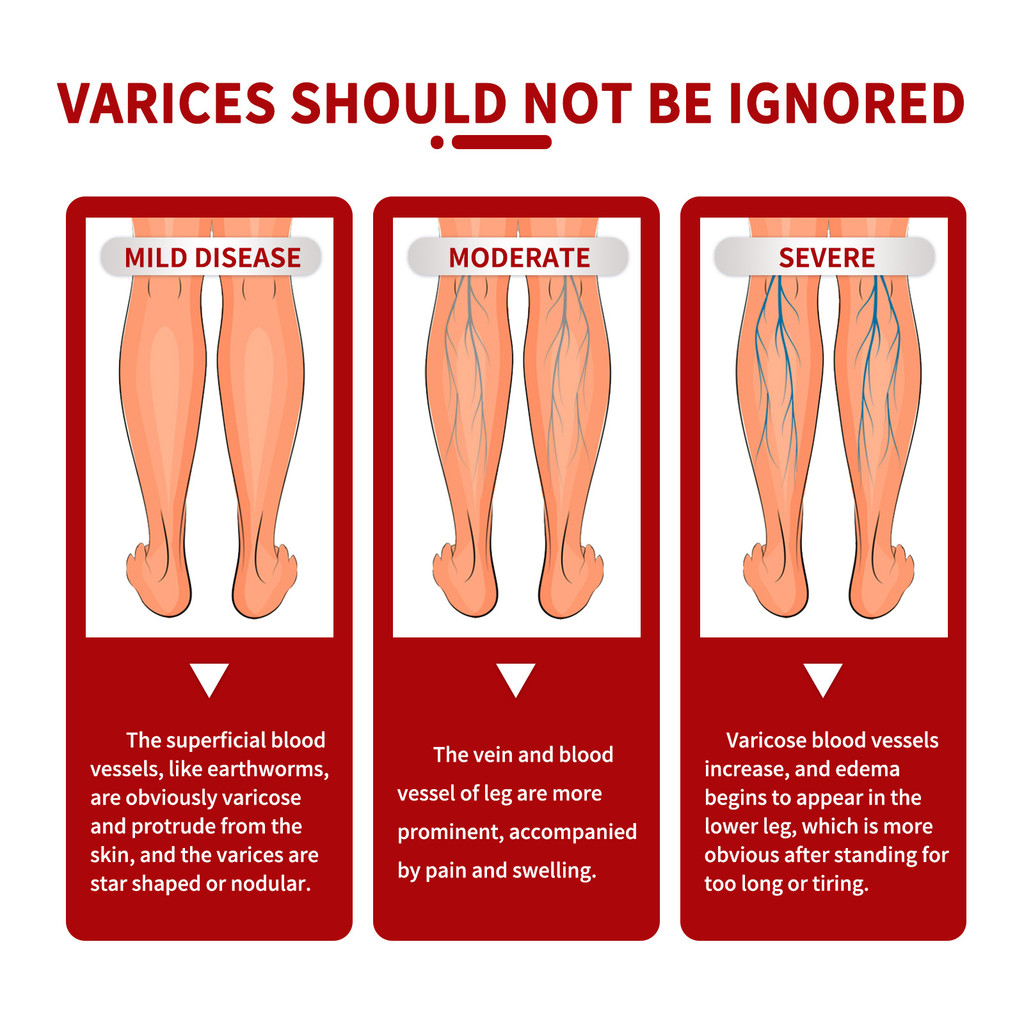 South Moon Varicose Veins Cream 20g Vein Repair Cream Varicose Vein