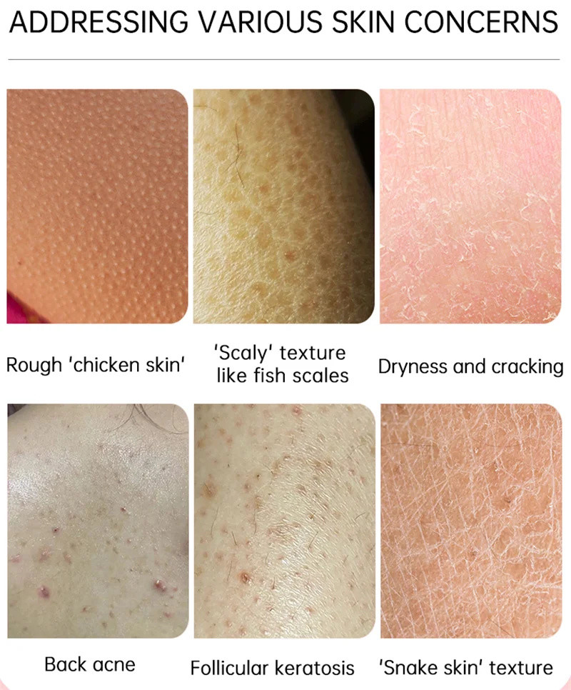 Body Whitening Cream Keratosis Pilaris Treatment Bumpy Rough Chicken ...