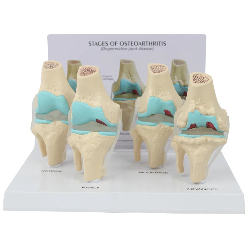 4pc/Set Lesion Knee Joint Model Morbidity 4-stage Knee Joint Model ...